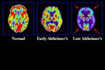 Alzheimers