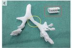 attelle 3d