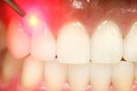 dents laser