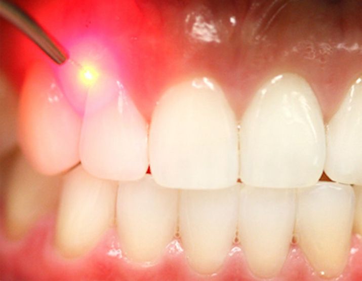 dents laser