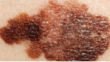 Un virus d'herpès modifié s'attaque au cancer de la peau : espoir en vue ?
