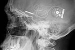 implant cerebral