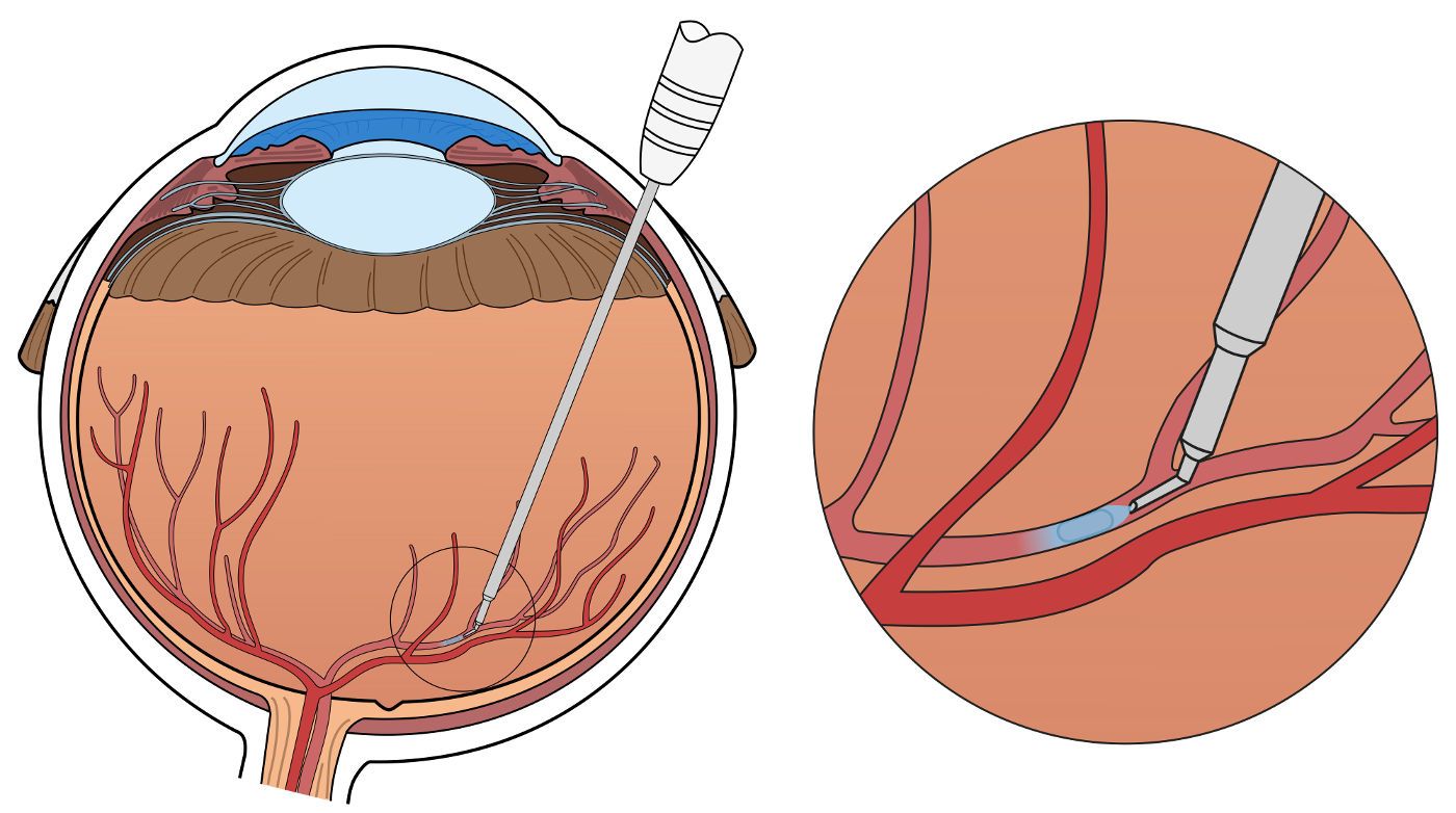 Injection oeil robot