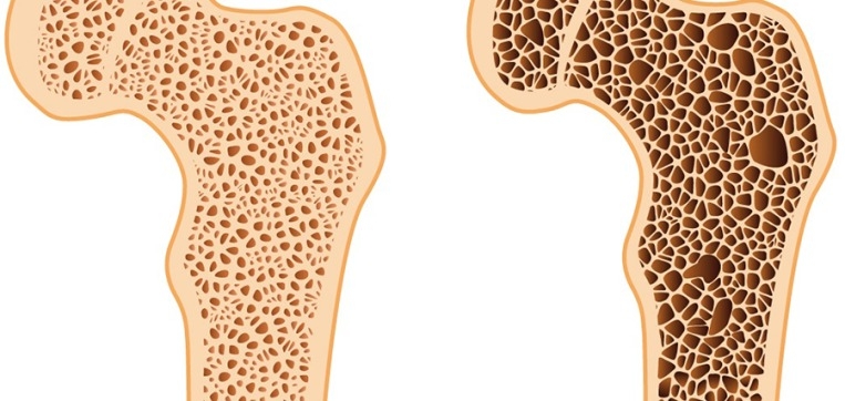 Osteoporose 02