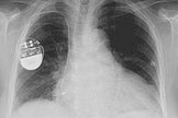 Les pacemakers sont un nid à vulnérabilités