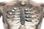 Prothèse thorax imprimée 3D