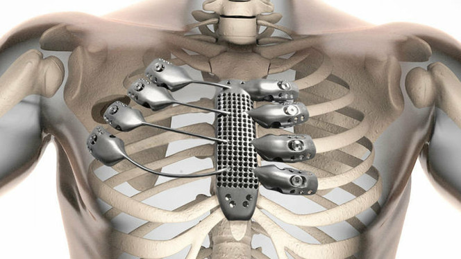 Prothèse thorax imprimée 3D