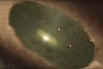 protoplanet