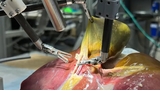 A la John Hopkins University, un robot chirurgien avec IA opère déjà seul sans intervention humaine