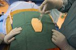 Sternum céramique